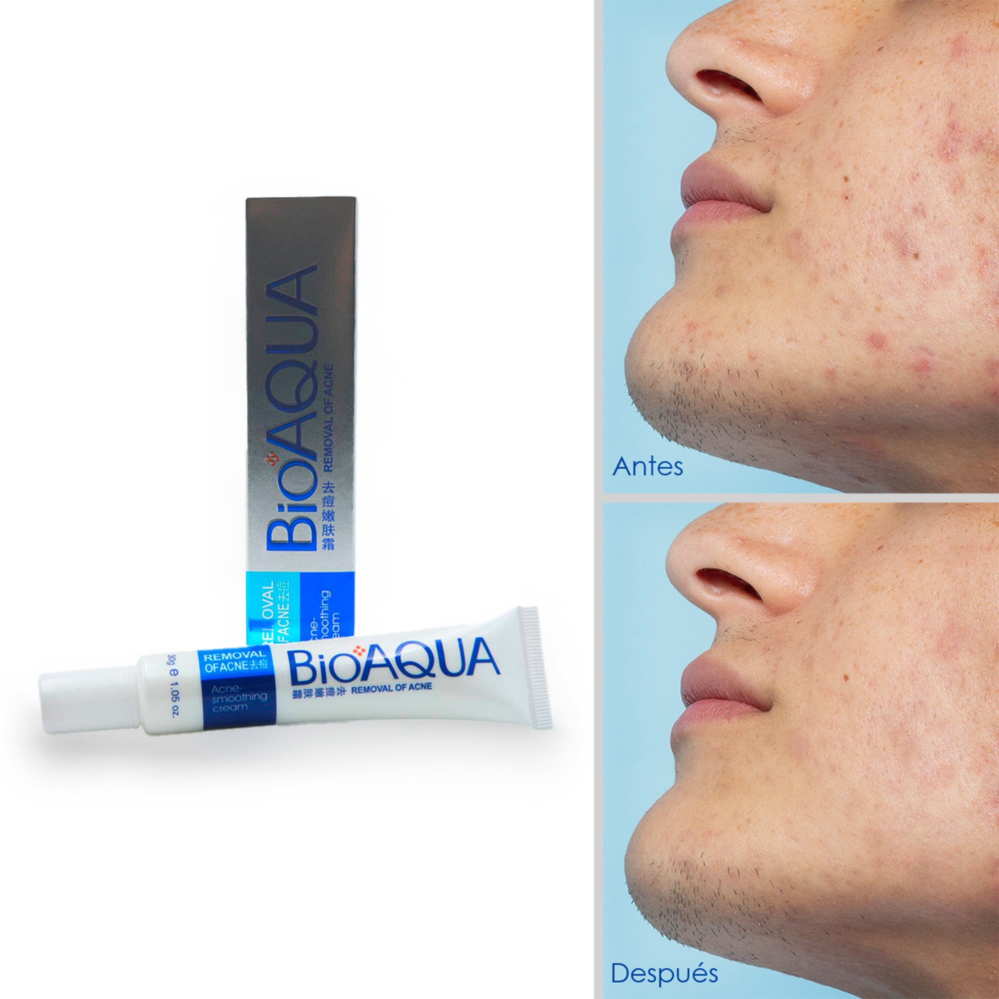 Crema Antiacne